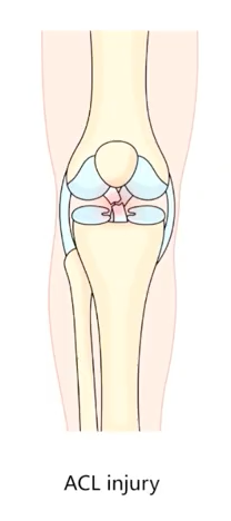 ACL Injury illustrated