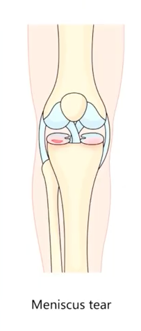 Meniscus Tear illustrated