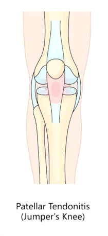 Patellar Tendonitis (Jumper's Knee) illustrated
